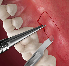 이식 조직 채취