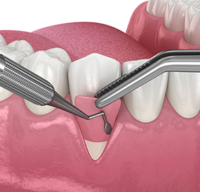 잇몸 이식 및 고정