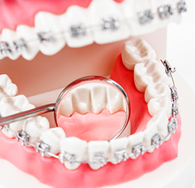 교정장치 제거 및 유지장치 부착