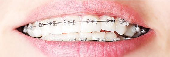 3. 자가결찰교정