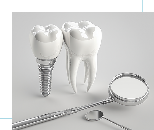 올온엑스 임플란트